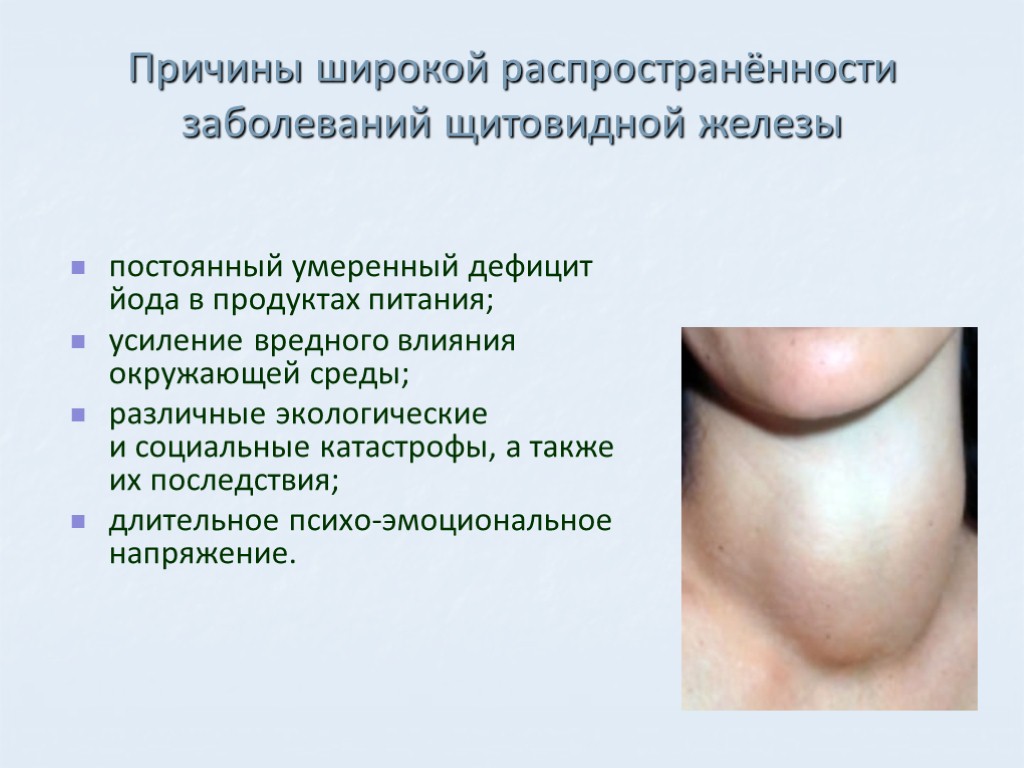 постоянный умеренный дефицит йода в продуктах питания; усиление вредного влияния окружающей среды; различные экологические